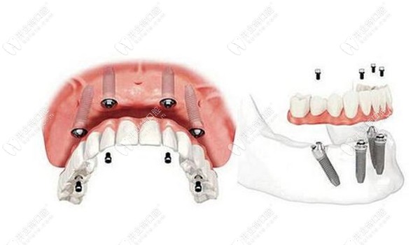 郑州乐植口腔allon4种植牙技术