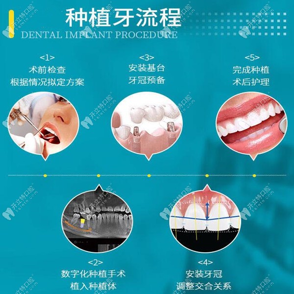 深圳和壹口腔种植牙流程图