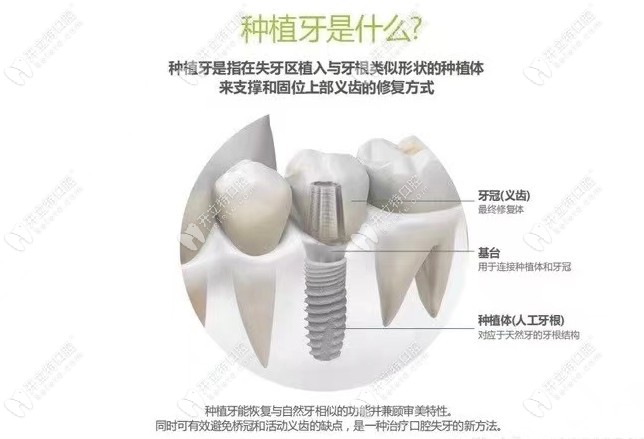 瞅瞅济宁种植牙多少钱一颗,壹颗芽口腔也可参考此价格呢