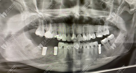 诉说在广州柏德口腔种牙前的惨痛经历,及种植牙的过程