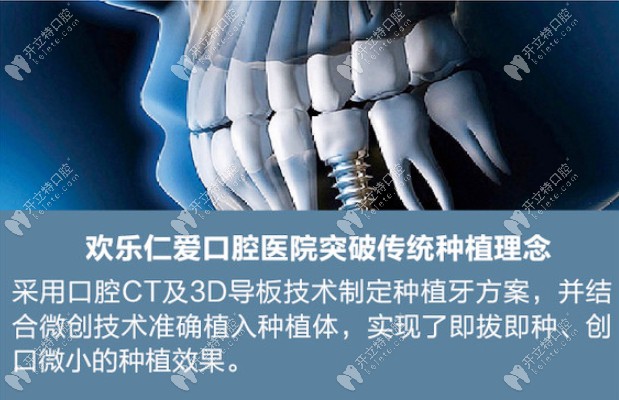 欢乐口腔种牙优势