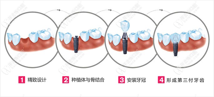 宝城口腔医院种植牙的收费是多少钱一颗