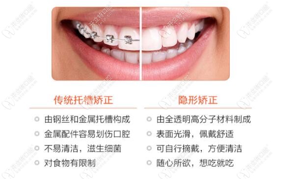 金属矫正和隐形矫正