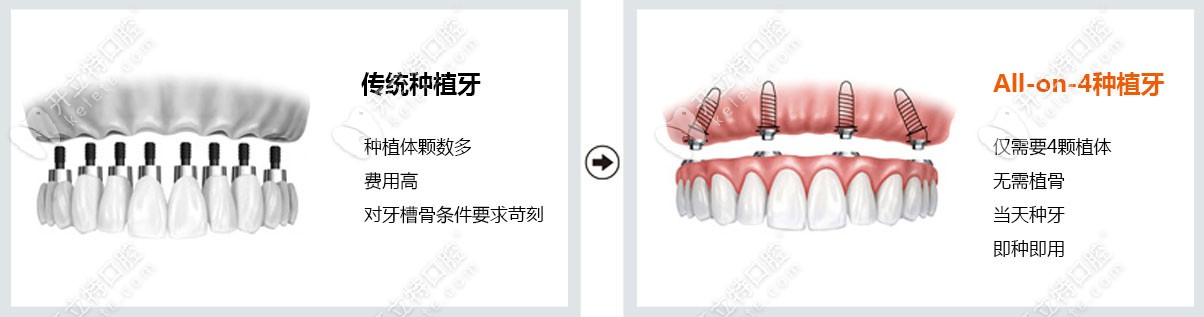 all-on-4种植牙技术