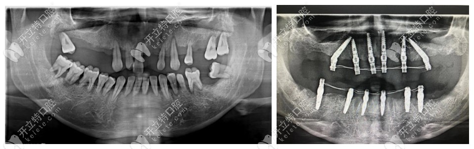 无锡北极星口腔的全口种植牙病例