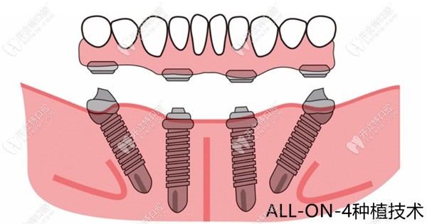 眾仁牙科all-on-4種植技術(shù)