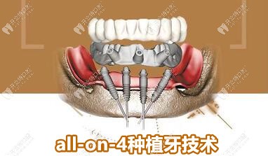 all-on-4种植牙技术，当天种植，当天吃饭