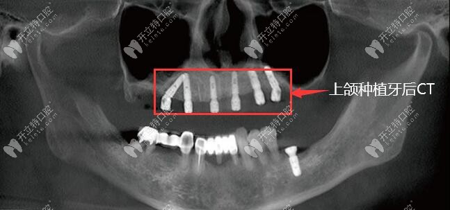 上半口all-on-6即刻负重种植牙的CT图片