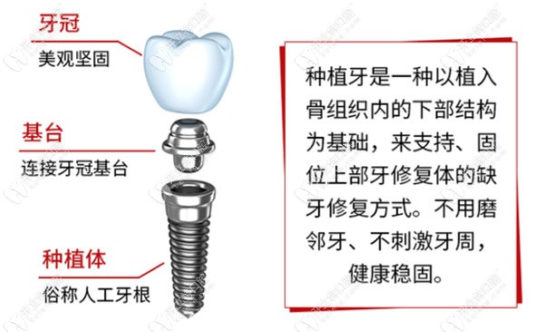 种植牙的基本简介