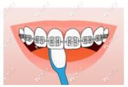 戴牙套后如何刷牙
