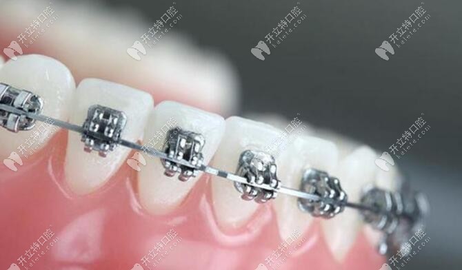 金属托槽牙齿矫正器