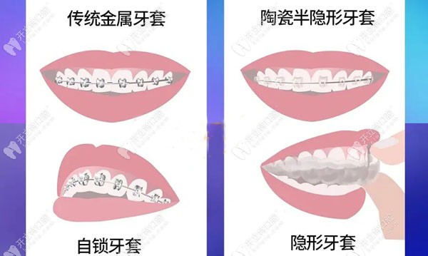 各类牙齿矫正器的选择方式及特色