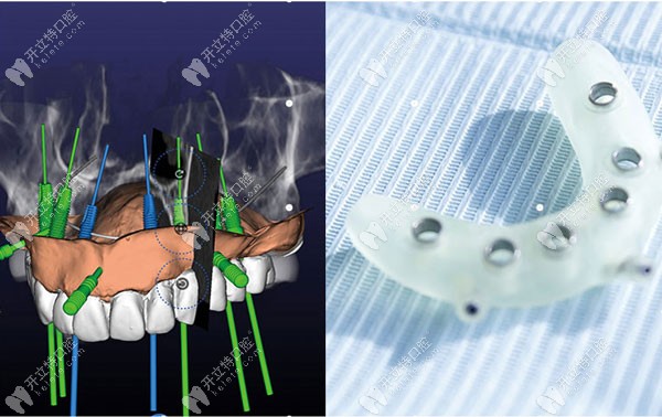 种植牙3D手术导板
