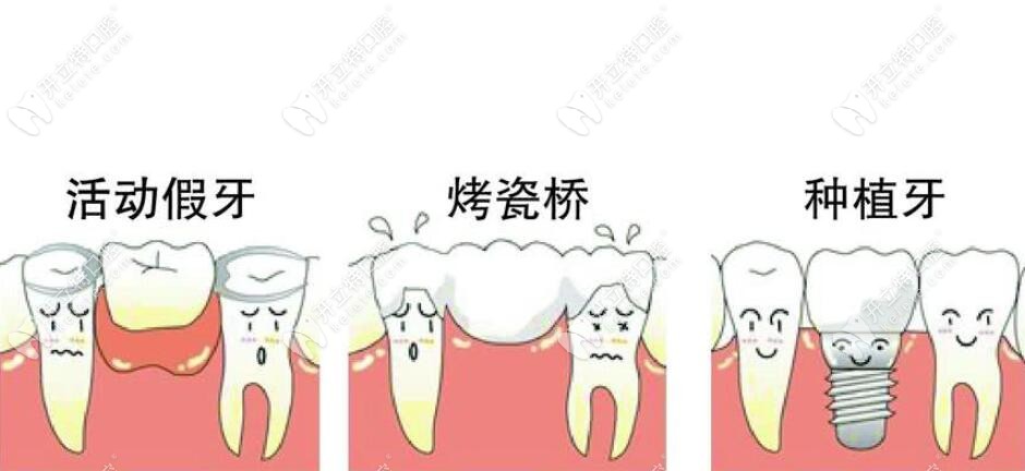 三种牙齿修复方式的区别