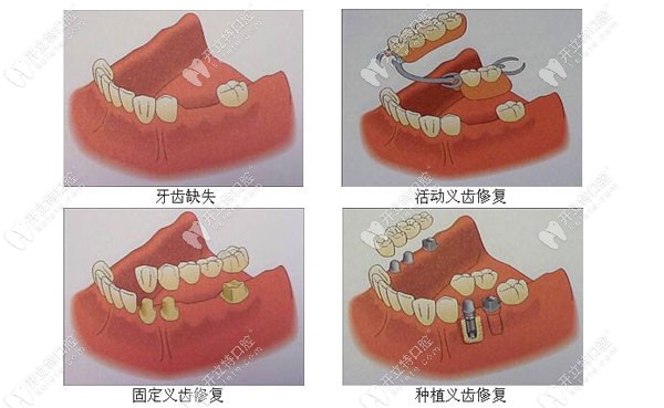 三种镶牙方式的区别