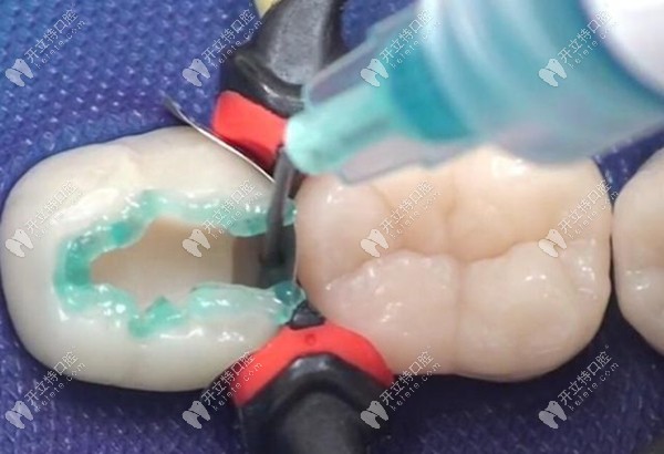 补牙时的磨牙过程