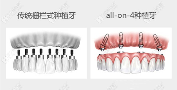 钛植牙科ALL-ON-4/6半全口即刻负重种植牙