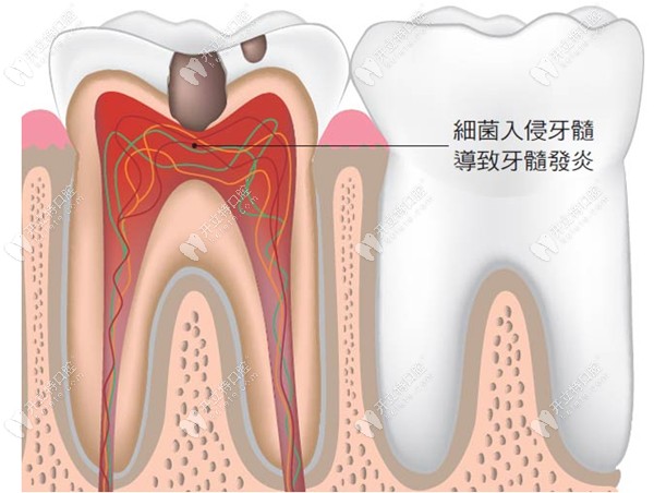 牙髓组织的炎症病变称为牙髓炎