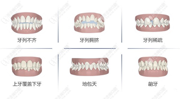 牙博士可矫正的畸形牙齿有哪些？