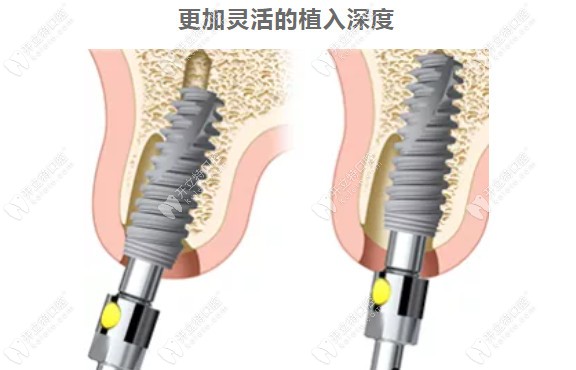 瑞典诺保科种植牙的优势