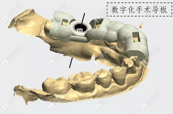 导板种植手术示意图