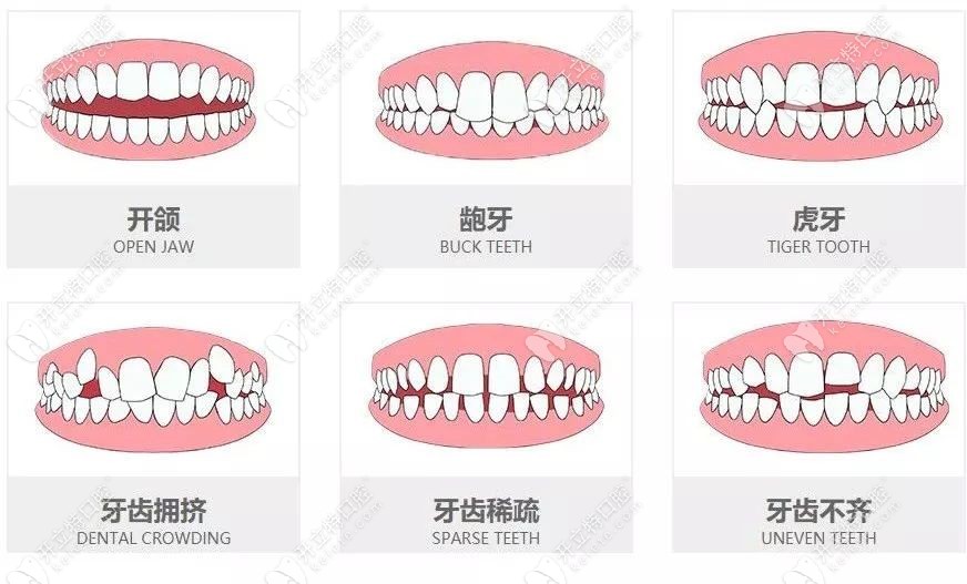 适合做牙齿矫正的情况