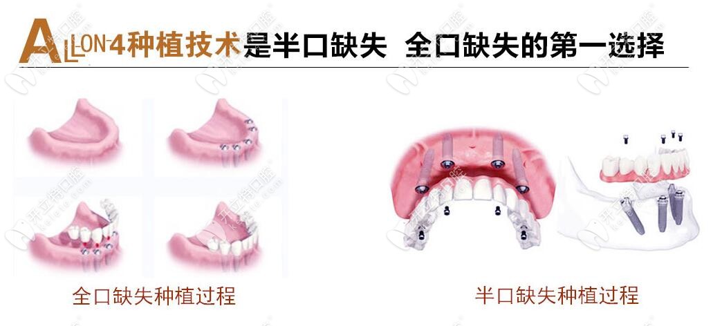 美奥口腔all-on-4种植牙技术特点