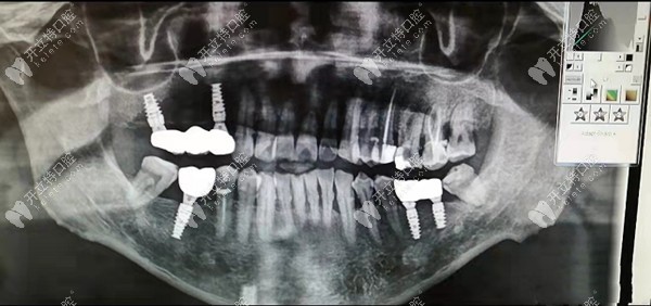 上下后牙缺失后种植的病例展示