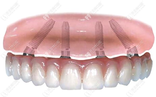 德伦口腔用ALL-ON-4种植技术做半口种植牙