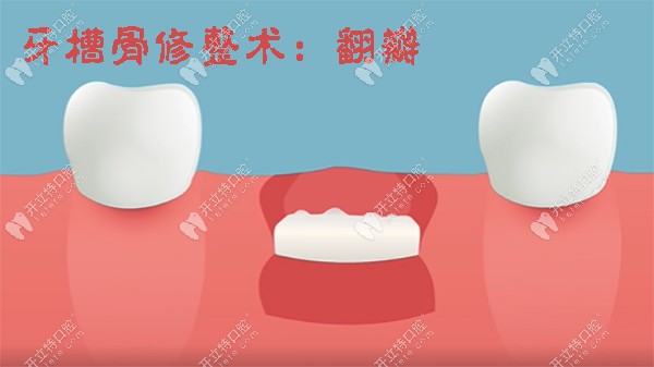 牙槽骨修整术的过程