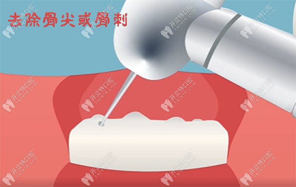 牙槽骨修整术一般多少钱
