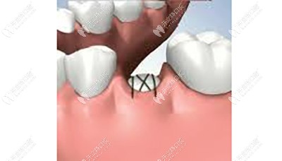 牙槽骨修整术的适应症