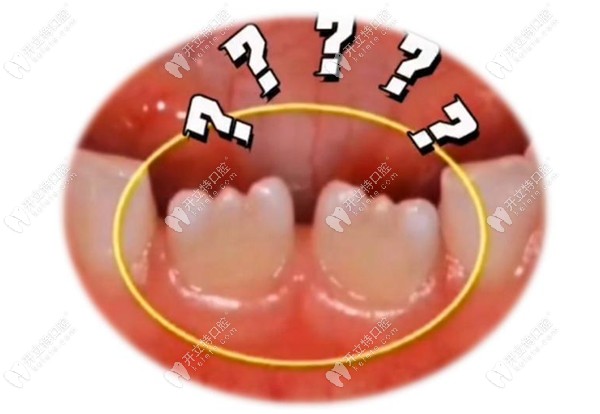 孩子新长出的牙齿不整齐呈锯齿状怎么办,长大了会消失吗？