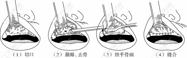 牙槽骨修整术的四个流程