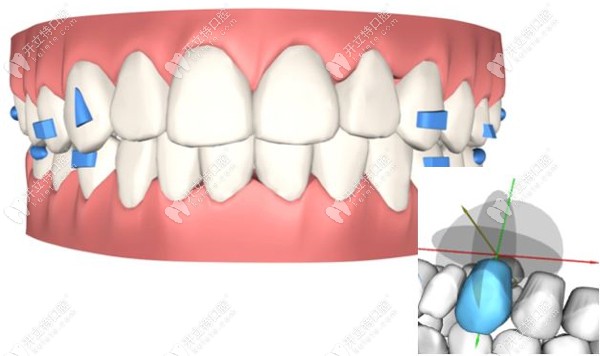 冯国印医生专攻各类牙齿矫正技术