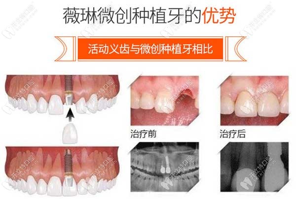 微創(chuàng)種植牙的優(yōu)勢(shì)