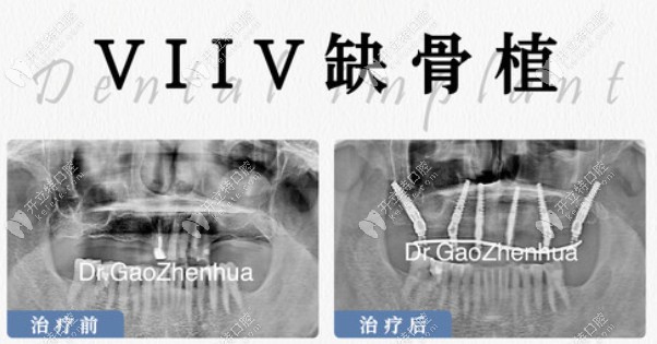 鼎植口腔VIIV缺骨种植牙前后对比图