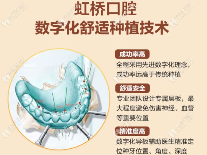 上海闵行区虹桥口腔数字化种植牙的优势