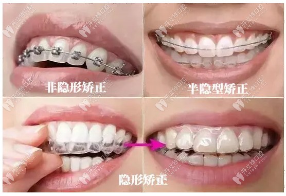各类牙齿矫正器的区别和样式