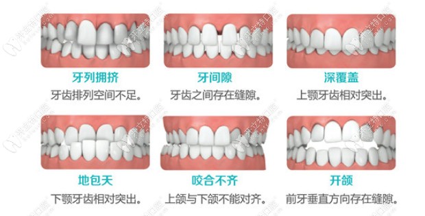 图解牙齿畸形需要矫正的类型