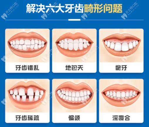 金属自锁箍牙器可以矫正的畸形牙齿