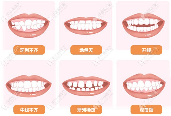 需要做正畸的牙齿问题