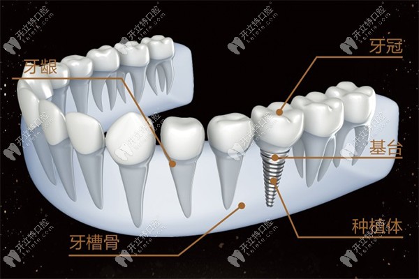 种植牙结构示意图