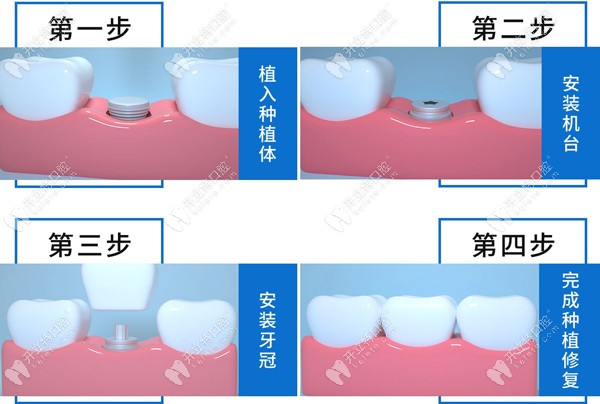 牙齿种植的步骤图