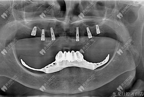 洛阳九龙口腔80岁老人的半口种植病例
