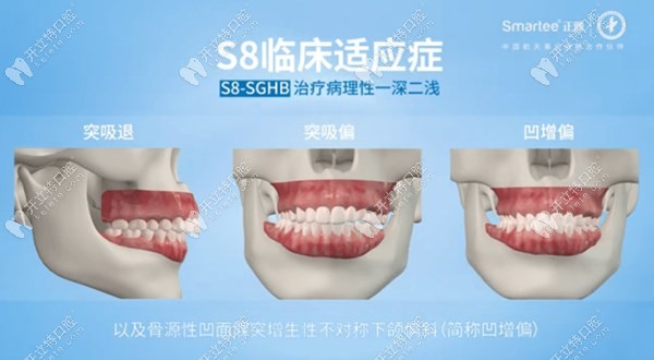 正雅S8隐形牙齿矫正器适应症