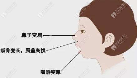 长期口呼吸：嘴巴变凸，下巴后缩