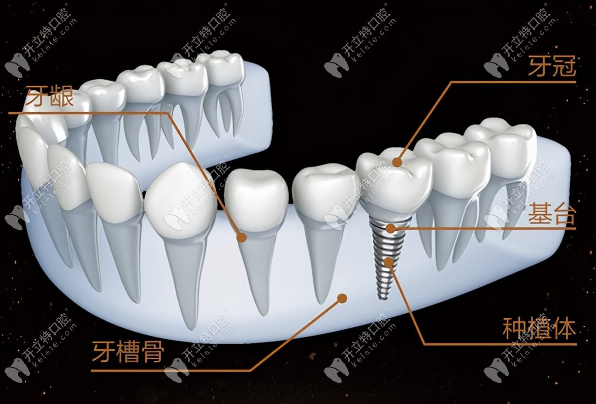 种植牙手术二期修复牙冠