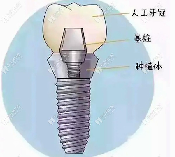 湖北荆州咿呀牙科的种植牙收费在此