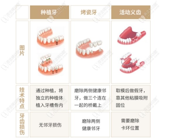 种植牙和活动义齿的区别